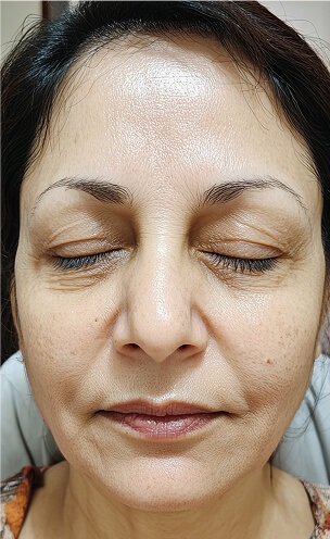 Primer plano de rostro femenino mostrando signos de envejecimiento natural, imagen ilustrativa del estado previo a un tratamiento de rejuvenecimiento facial