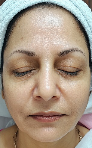 Primer plano de rostro femenino con piel uniforme y expresión relajada, imagen representativa del resultado de un tratamiento de rejuvenecimiento facial