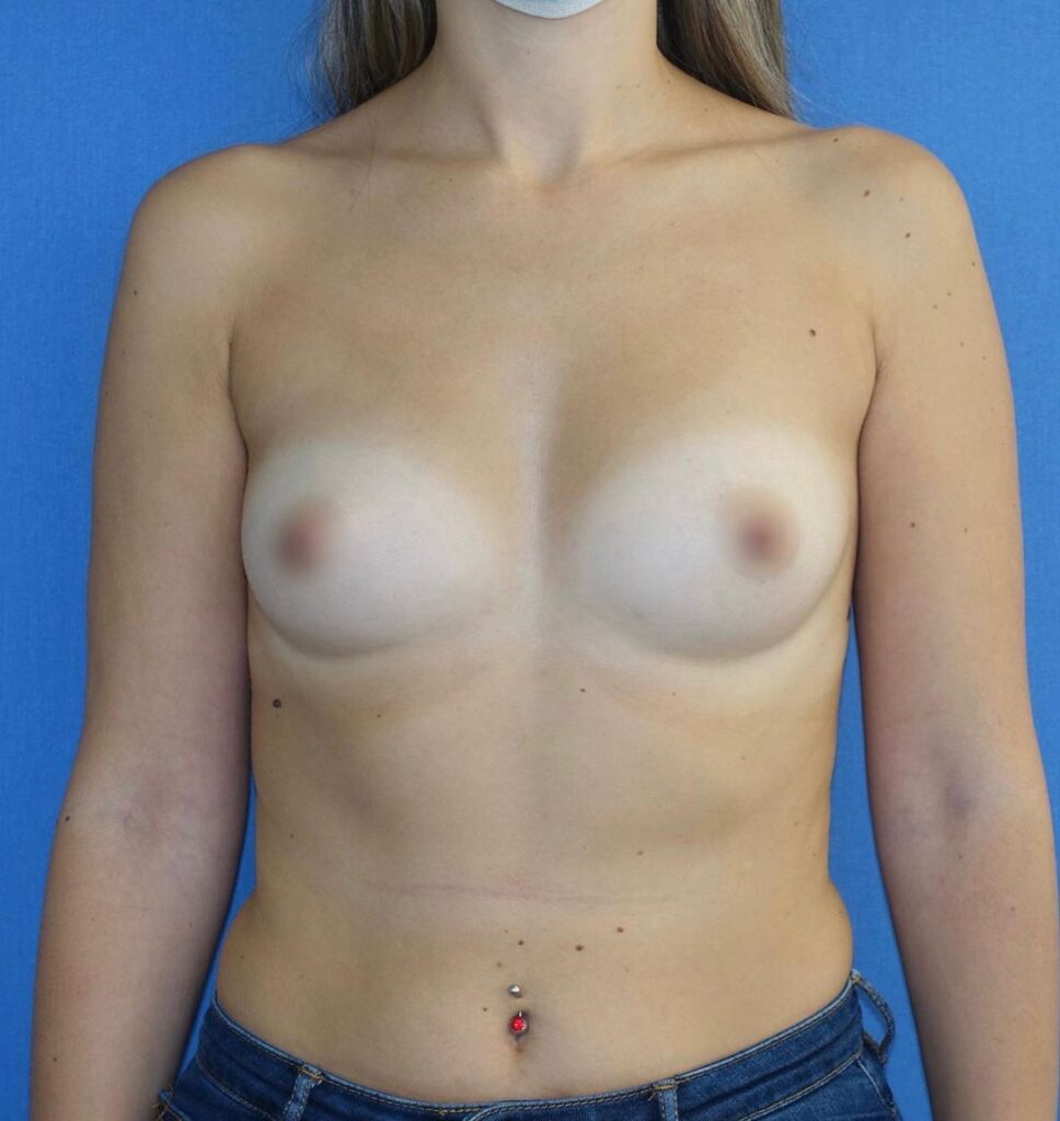 Foto preoperatoria de paciente antes de un aumento de mama, mostrando el estado inicial del pecho previo a la intervención